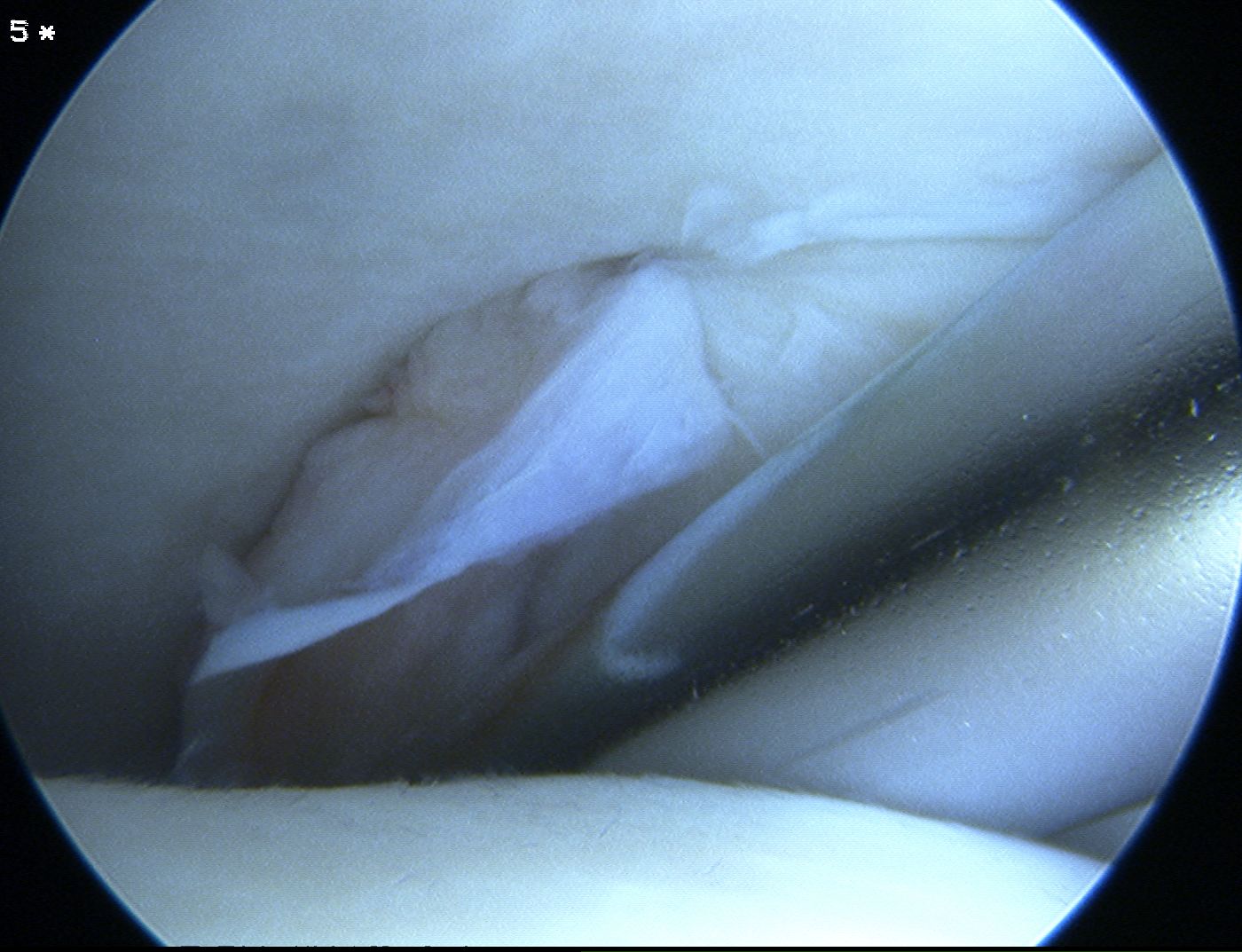 Ankle scope syndesmosis 2